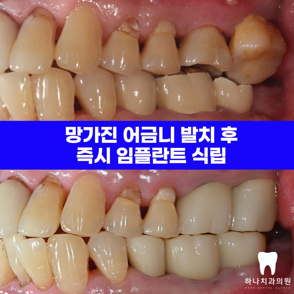 신정동어금니임플란트