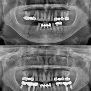 울산삼산임플란트